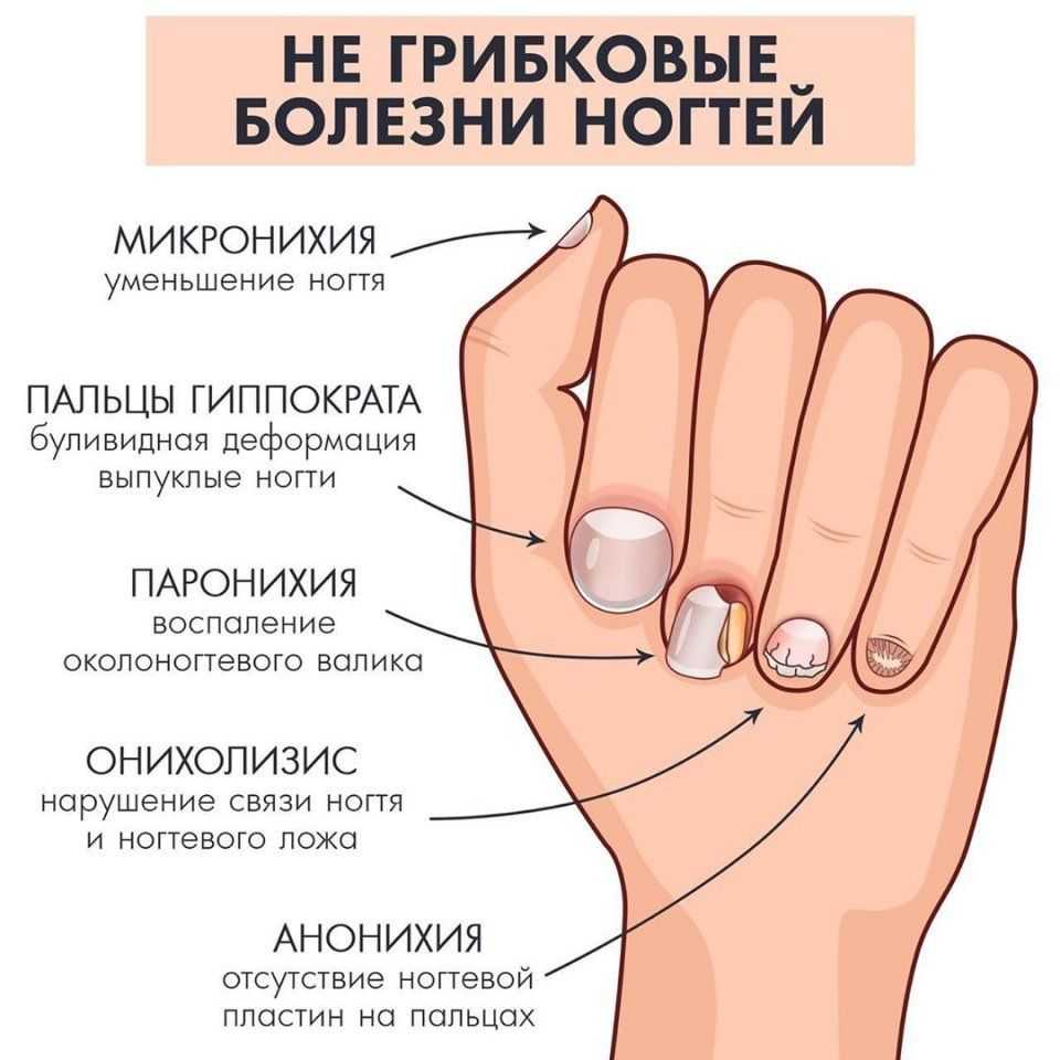 Ноготь отвалился по соннику - значение для женщины