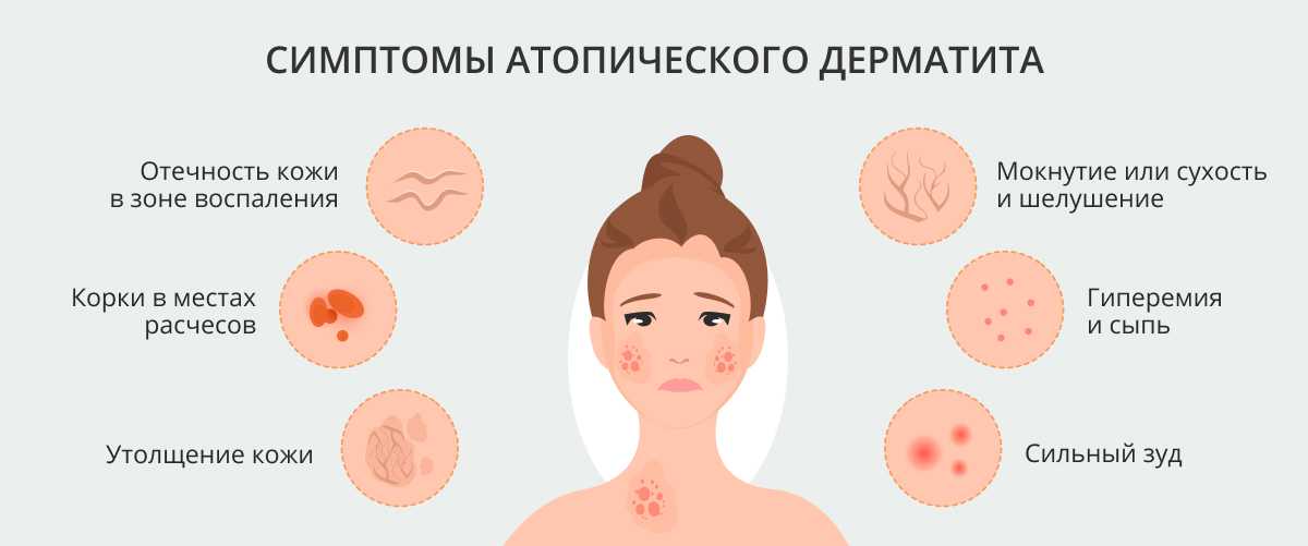 Мази от аллергии на коже у взрослых - рейтинг лучших