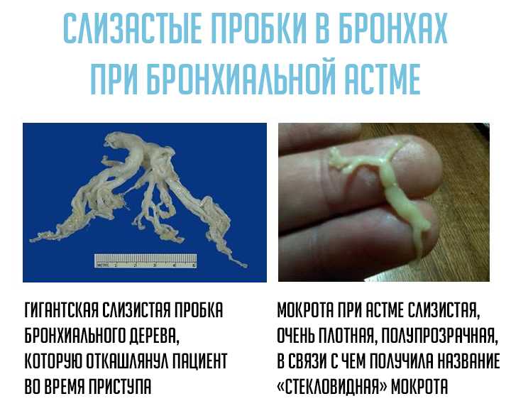 Гиперсаливация у взрослых и детей, причины выделения слюны во время сна