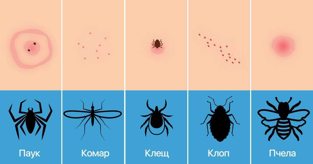 Блохи на людях живут или нет, кусают ли блохи людей, как избавиться